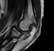 Elbow Malunion MRI